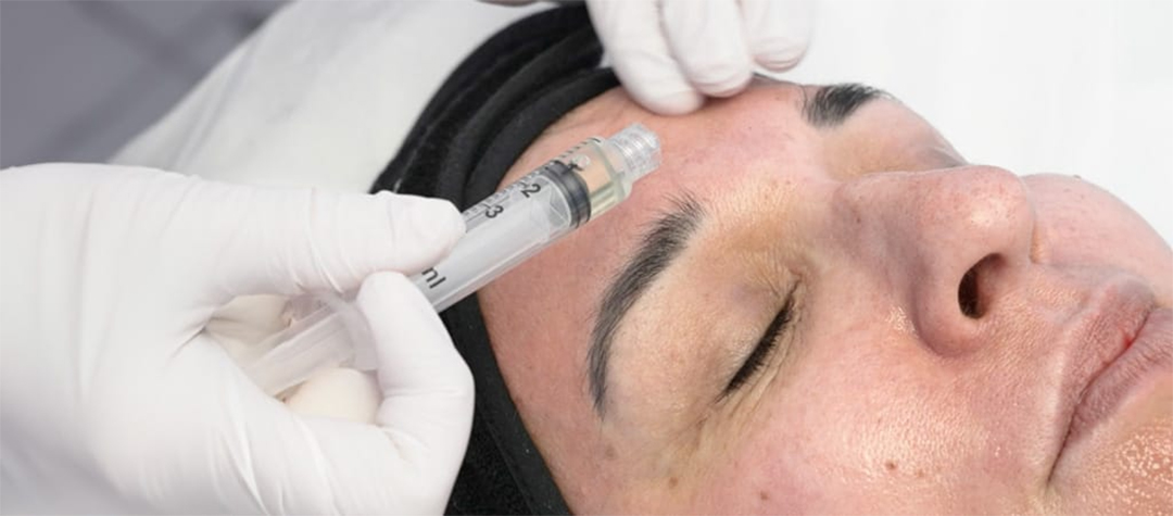 bianca-SkinRetin-Microneedling